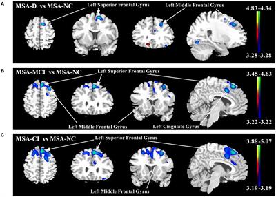 Cerebral Metabolism Related to Cognitive Impairments in Multiple System Atrophy